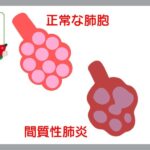 間質性肺炎