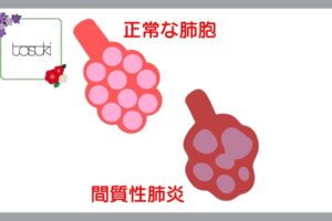 間質性肺炎