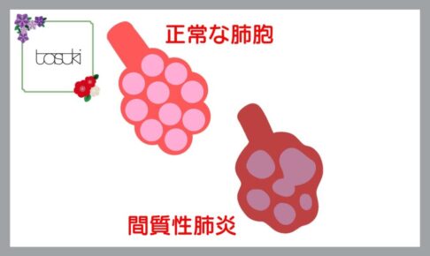 間質性肺炎