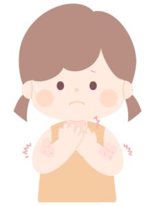 湿疹の出ている女の子