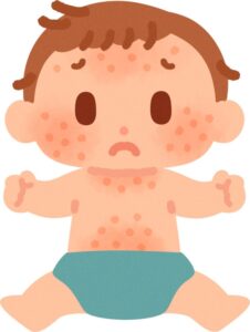 湿疹の出ている男の子