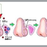 好酸球性副鼻腔炎