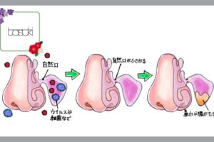 好酸球性副鼻腔炎