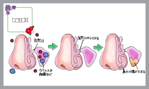 好酸球性副鼻腔炎