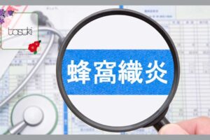 蜂窩織炎
