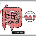 クローン病