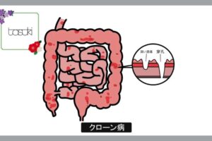 クローン病