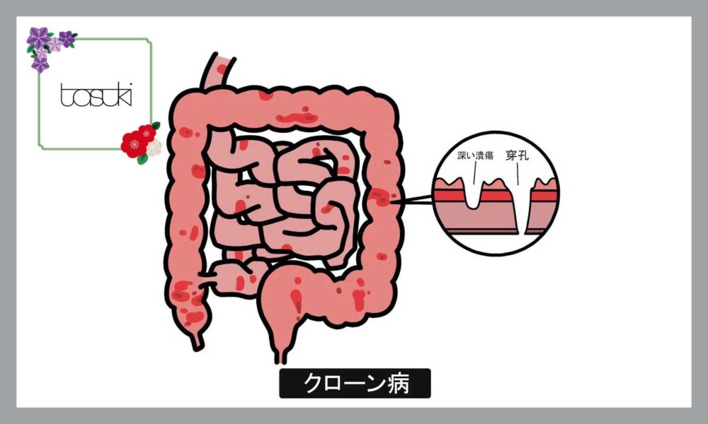 クローン病