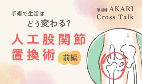手術で生活はどう変わる？人工股関節置換術前編というテキストと股関節のイラスト