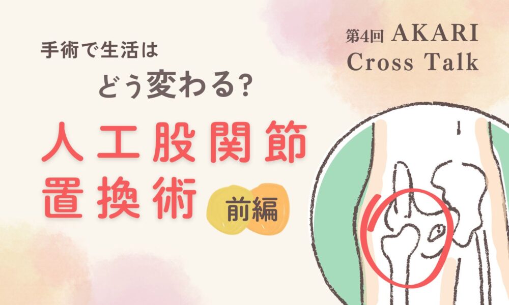 手術で生活はどう変わる?人工股関節置換術前編というテキストと股関節のイラスト