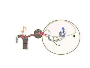 人工内耳の仕組みを解説した画像